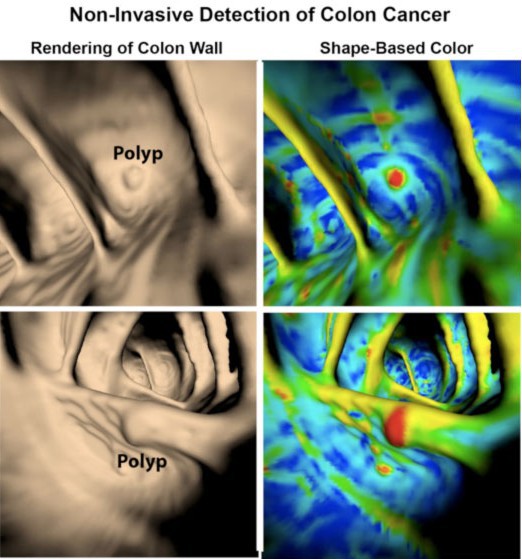 CT-based images of the colon wall processed to aid identification of polyps.